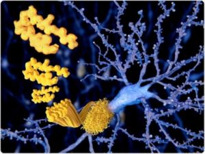 Model of beta amyloid plaques on neurons.